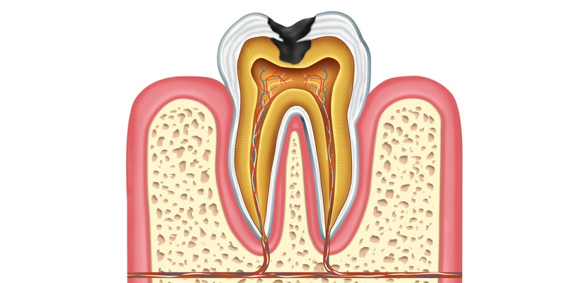 dureri articulare din cariile dentare)