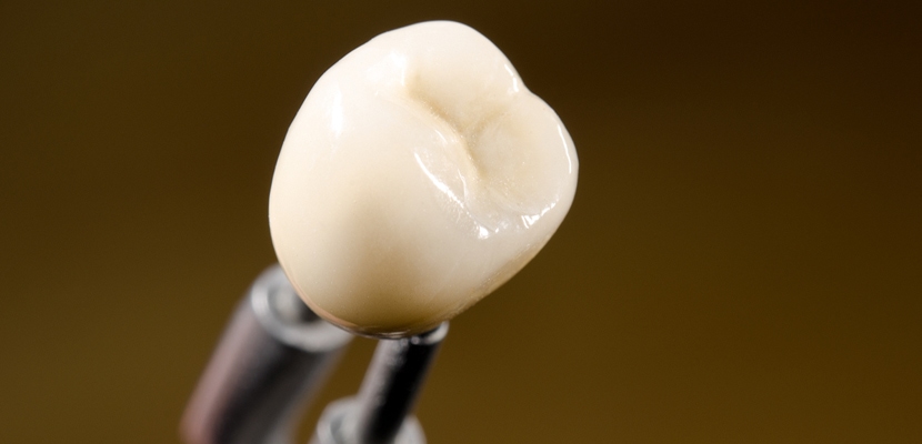 Coroane dentare