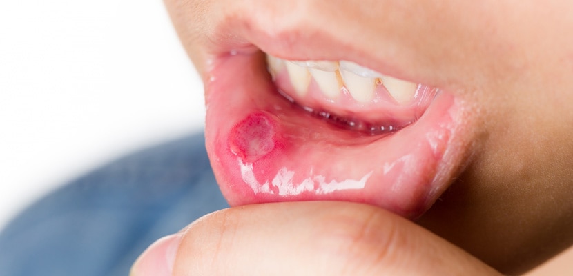 Gura uscată - Cauzele sindromului de gură uscată | Colgate